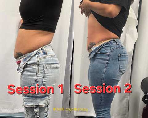 Cryo Slimming Packages service