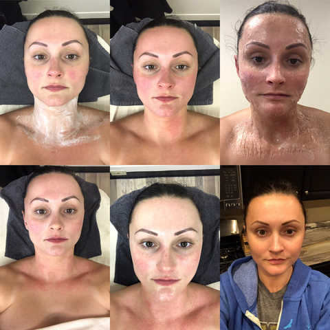 Corrective facial