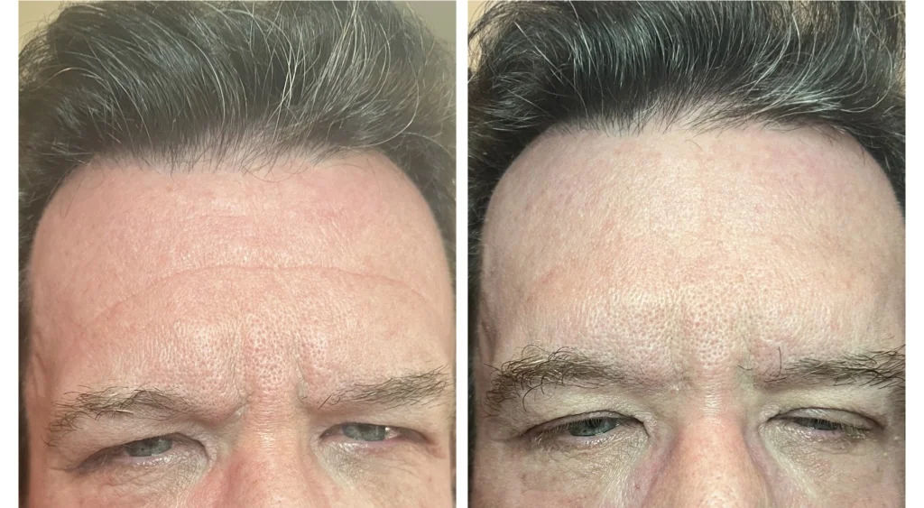  before and after,skin treatment,forehead,wrinkle reduction  