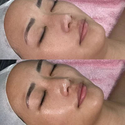 facial,skincare,before-and-after,beauty-treatment 