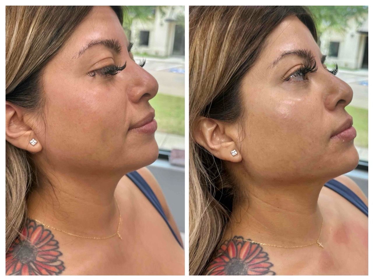  before and after,beauty treatment,facial transformation 