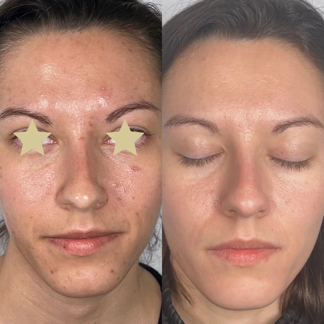  skin-treatment,before-and-after,facial-improvement  