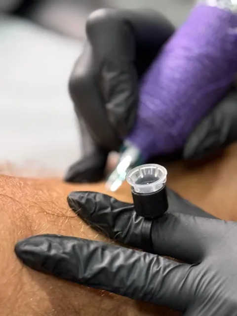 Inkless Scar/Stretchmark Revision (ISR) service