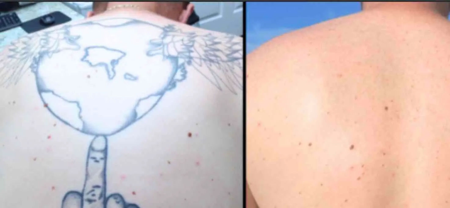 Laser Tattoo Removal