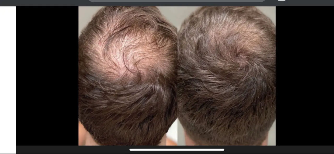 Hair Restoration
