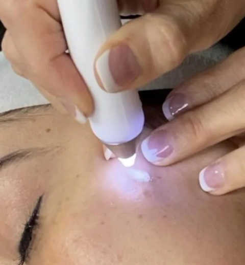 Spot Removal Treatments service