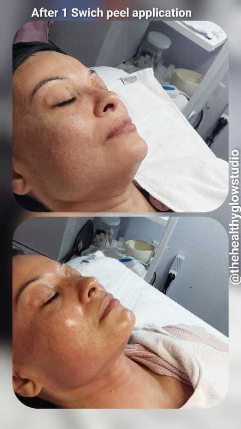 SWiCH Dermal Peel+Raspberry Enzyme Treatment plus Post-care Kit.