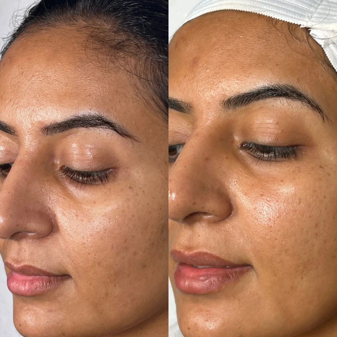  before-and-after,facial,skin-care,treatment  