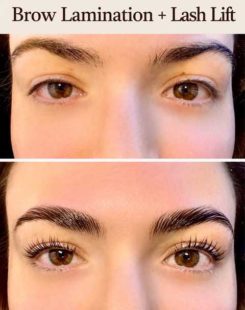 Microneedling