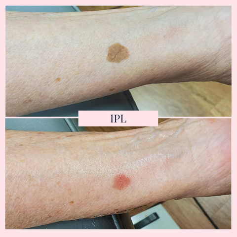 IPL Photofacial Lumecca - Spot Treatment