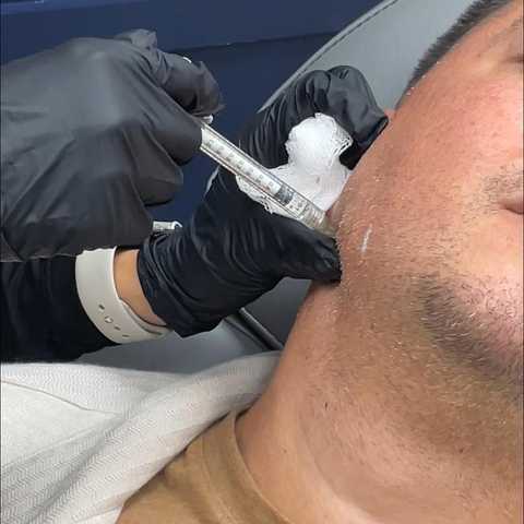 Dermal Fillers