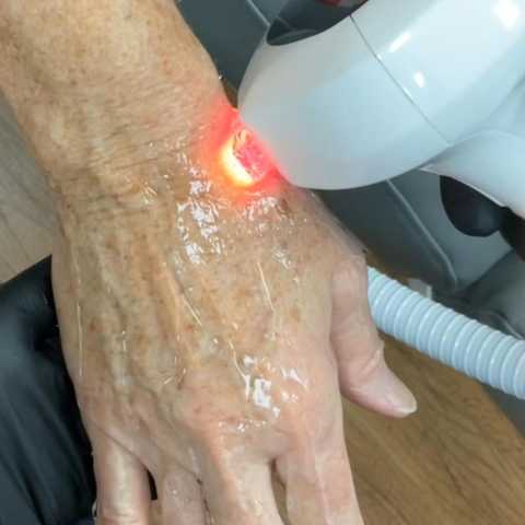 IPL Photofacial Lumecca - Spot Treatment