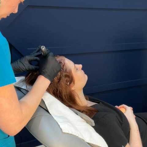 Microneedling - Hair Restoration with PRP