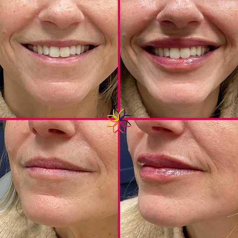 Dermal Fillers