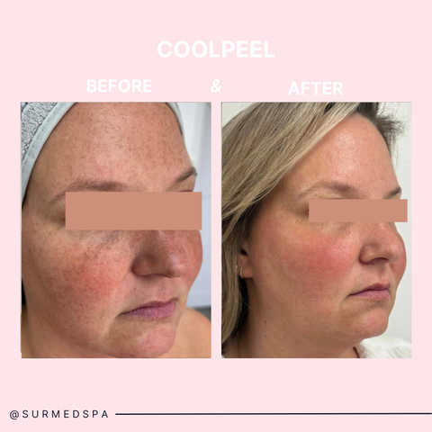 CoolPeel - Full Face