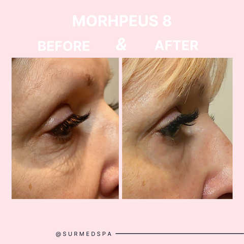 RF Microneedling Morpheus8 - Full Face