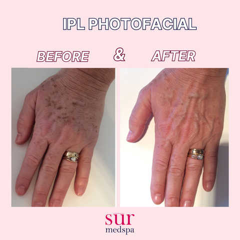 IPL Photofacial Lumecca - Face + Neck or Arms