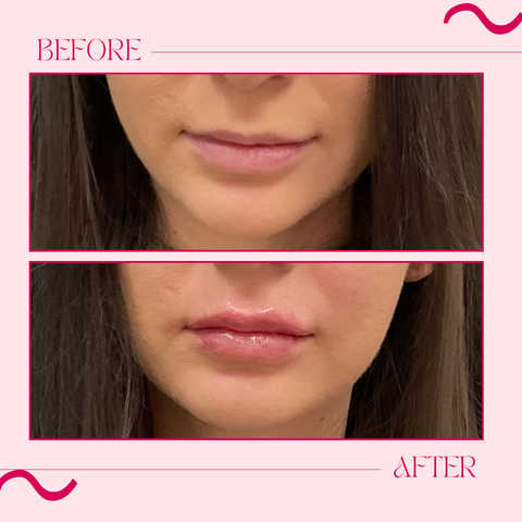 Dermal Fillers