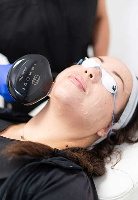 Lumecca- Intense Pulsed Light (IPL) Treatment-Improves Sun Damage,Age Spot, Hyperpigmentation, and Freckles service