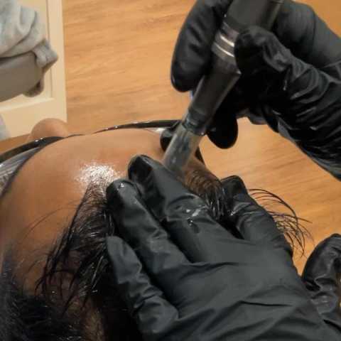 Microneedling - Hair Restoration with PRP