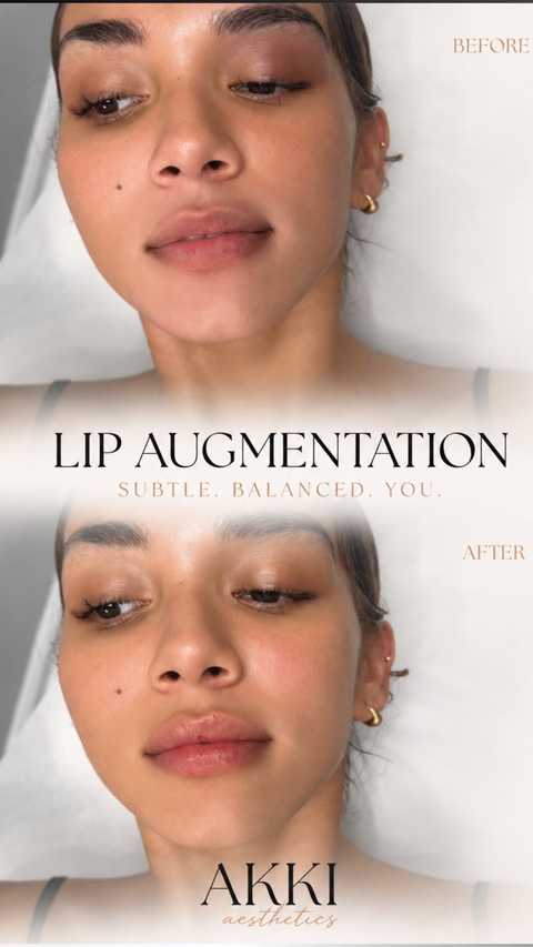 Lip Filler (1ML)