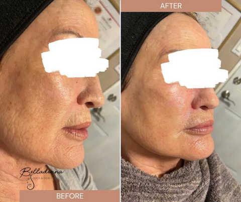 Facial carboxy with mask and light therapy