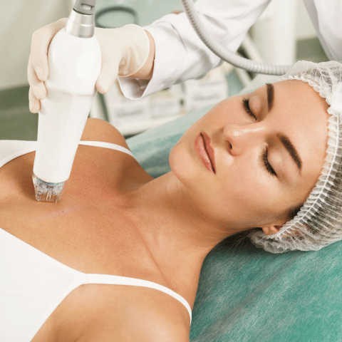 RF Microneedling Decoltte