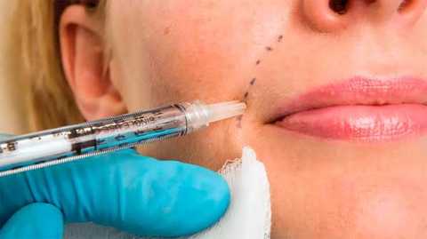 Cheek Filler - 2 syringes Juvederm Voluma XC