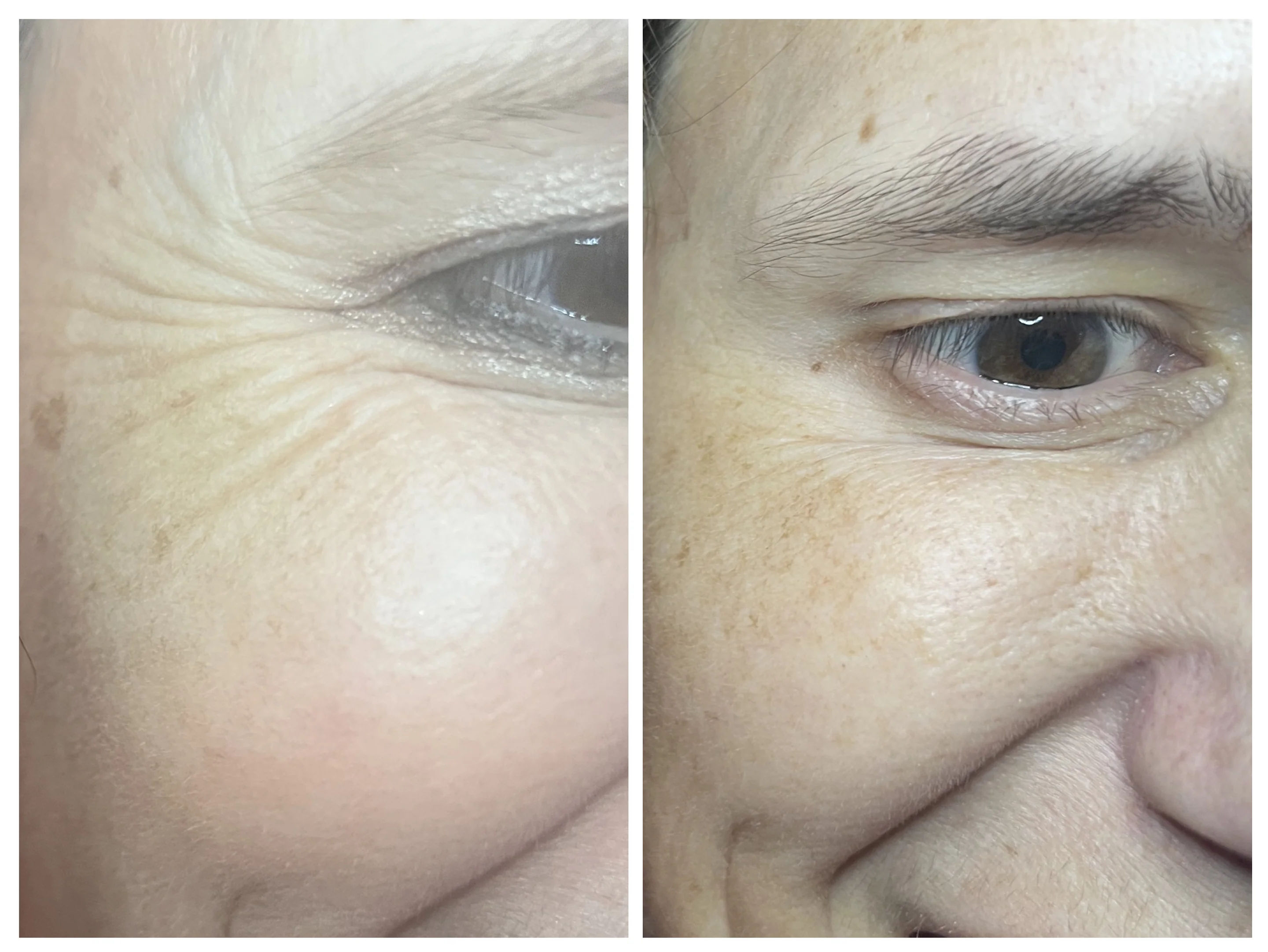  before and after,eye area,skin texture,comparison  