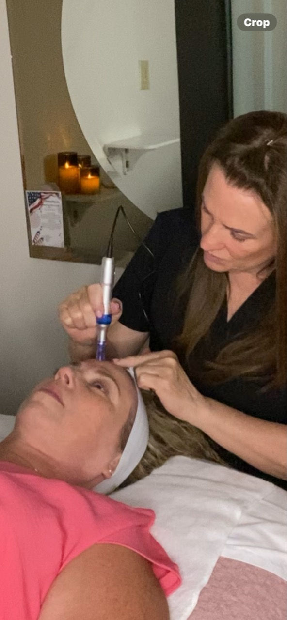 Microneedling