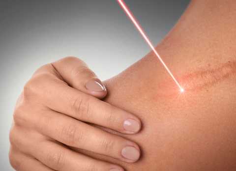 Scar removal service