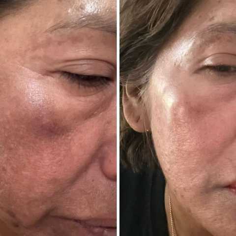Anti Aging Facial