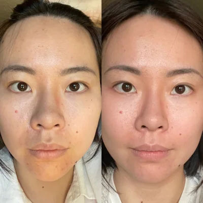  before-and-after,facial-treatment,skin-care 