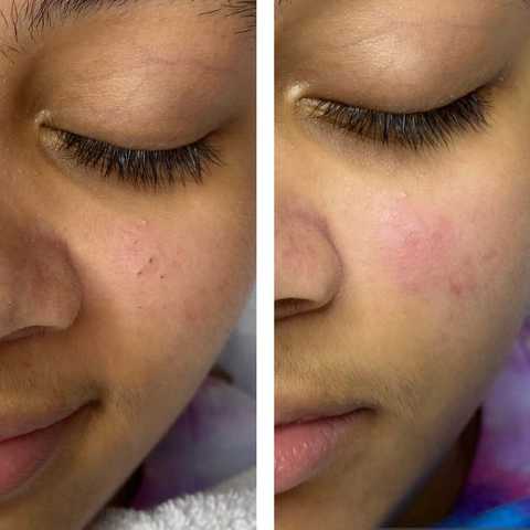 Teen Clean Facial