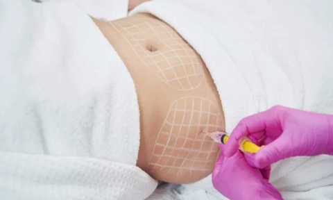 Intra Lipo Therapy service