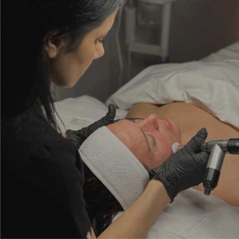 Microneedling With Stem Cells