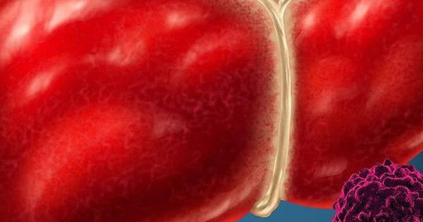 Ung thư gan: Nguyên nhân và cách phòng ngừa