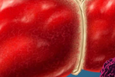 Ung thư gan: Nguyên nhân và cách phòng ngừa