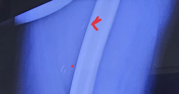 Nguy cơ nhiễm giun sán từ thói quen ăn uống hấp dẫn