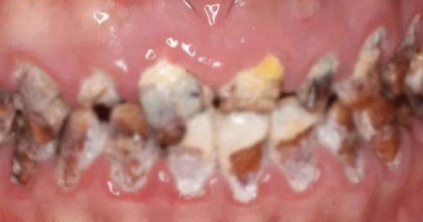 Bài viết: Hồn nhiên giữa hàm răng và vấn đề từ nước ngọt có ga