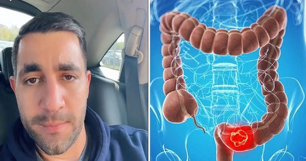 Khám Phá Những Dấu Hiệu Cảnh Báo Ung Thư Đại Trực Tràng Bạn Có Thể Đã Bỏ Qua