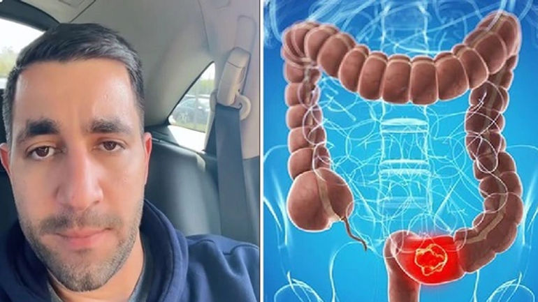 Khám Phá Những Dấu Hiệu Cảnh Báo Ung Thư Đại Trực Tràng Bạn Có Thể Đã Bỏ Qua