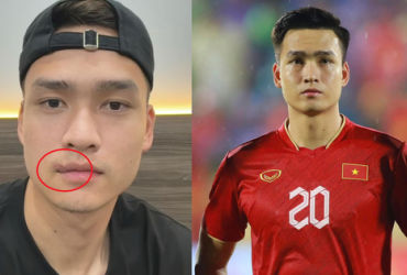 Vết Rách Môi của Bùi Hoàng Việt Anh: Sự Kiên Cường và Phong Độ Không Hề Sụt Giảm