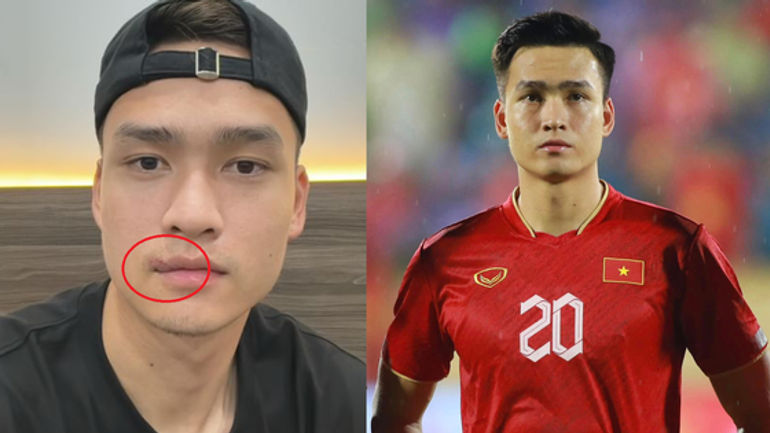 Vết Rách Môi của Bùi Hoàng Việt Anh: Sự Kiên Cường và Phong Độ Không Hề Sụt Giảm