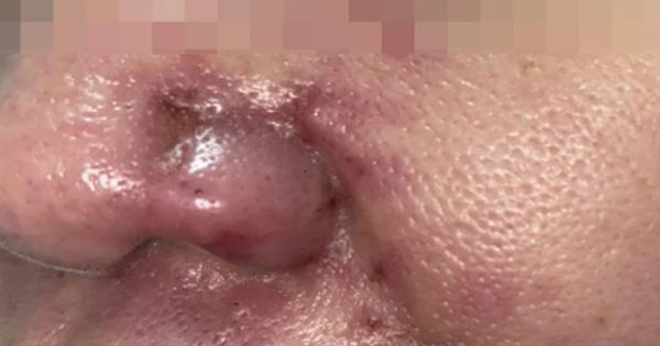 Nguy cơ khi tiêm filler tại cơ sở làm đẹp không uy tín