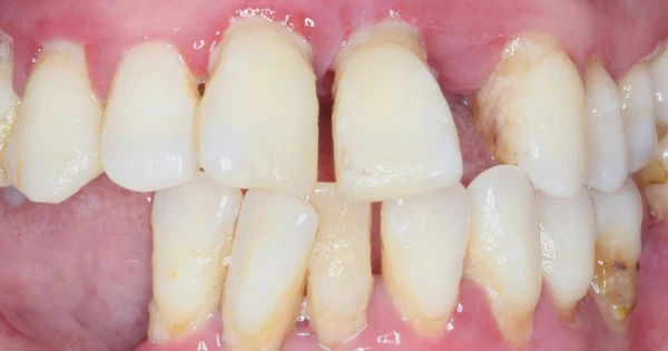 Bí quyết giữ cho răng săn chắc và nướu khỏe mạnh