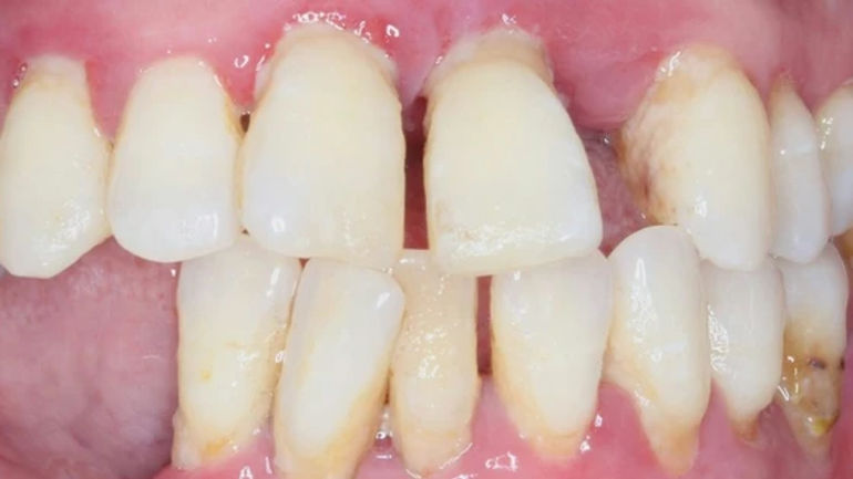 Bí quyết giữ cho răng săn chắc và nướu khỏe mạnh