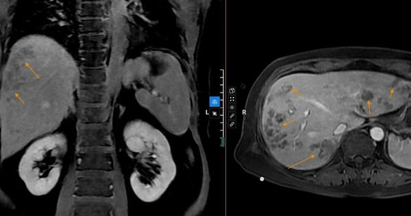 Khám phá về Sán Lá Gan: Nguy cơ tiềm ẩn từ thói quen ăn uống hàng ngày