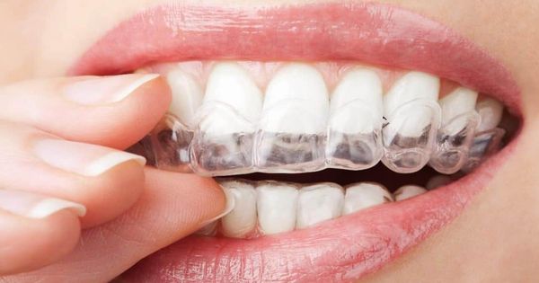 Phương pháp niềng răng hiệu quả: Khám phá ưu điểm và hạn chế