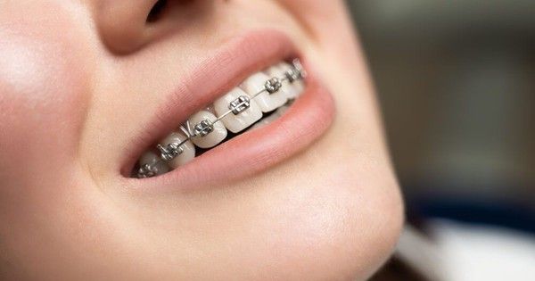 10 điều bạn chưa biết về niềng răng